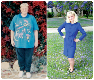 Before & After Weight Loss Surgery